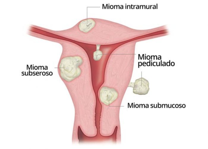 miomas-1