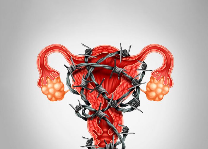 post-endometriose-vs-estresse-oxidativo