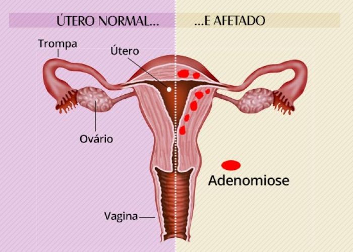 sabe-o-que-adenomiose